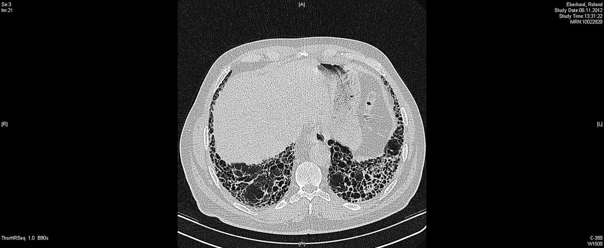 Two side-by-side high-resolution CT slices of a patient's chest showing patchy white scarring and small cyst-like spaces at the edges of both lungs