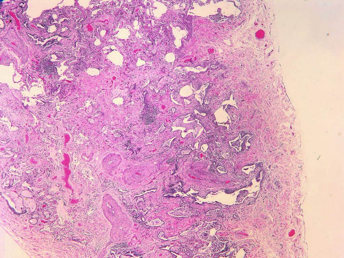 Microscope image of lung tissue stained pink and purple, showing dense scar tissue with scattered open, irregular air spaces